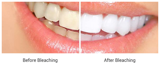 Bleaching Teeth Whitening