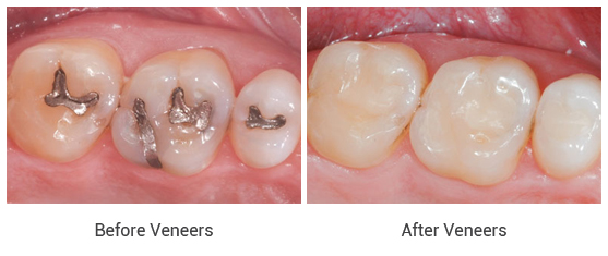 Composite Fillings