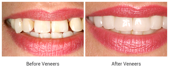 Porcelain Veneers