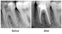 Root Canal