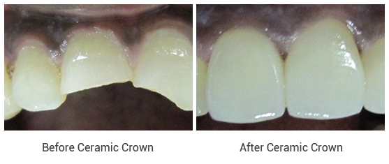 Porcelain Crowns